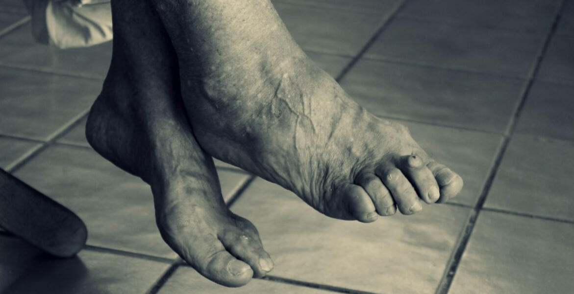 Advanced Foot Care - Saving Soles and Toes